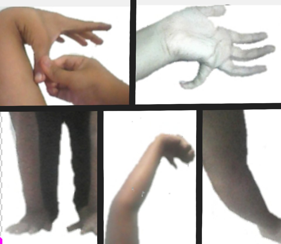 The Beighton score manoeuvres for joint hypermobility — bending the wrist and thumb, hyperextending the elbow and knee, and placing palms flat on the floor.