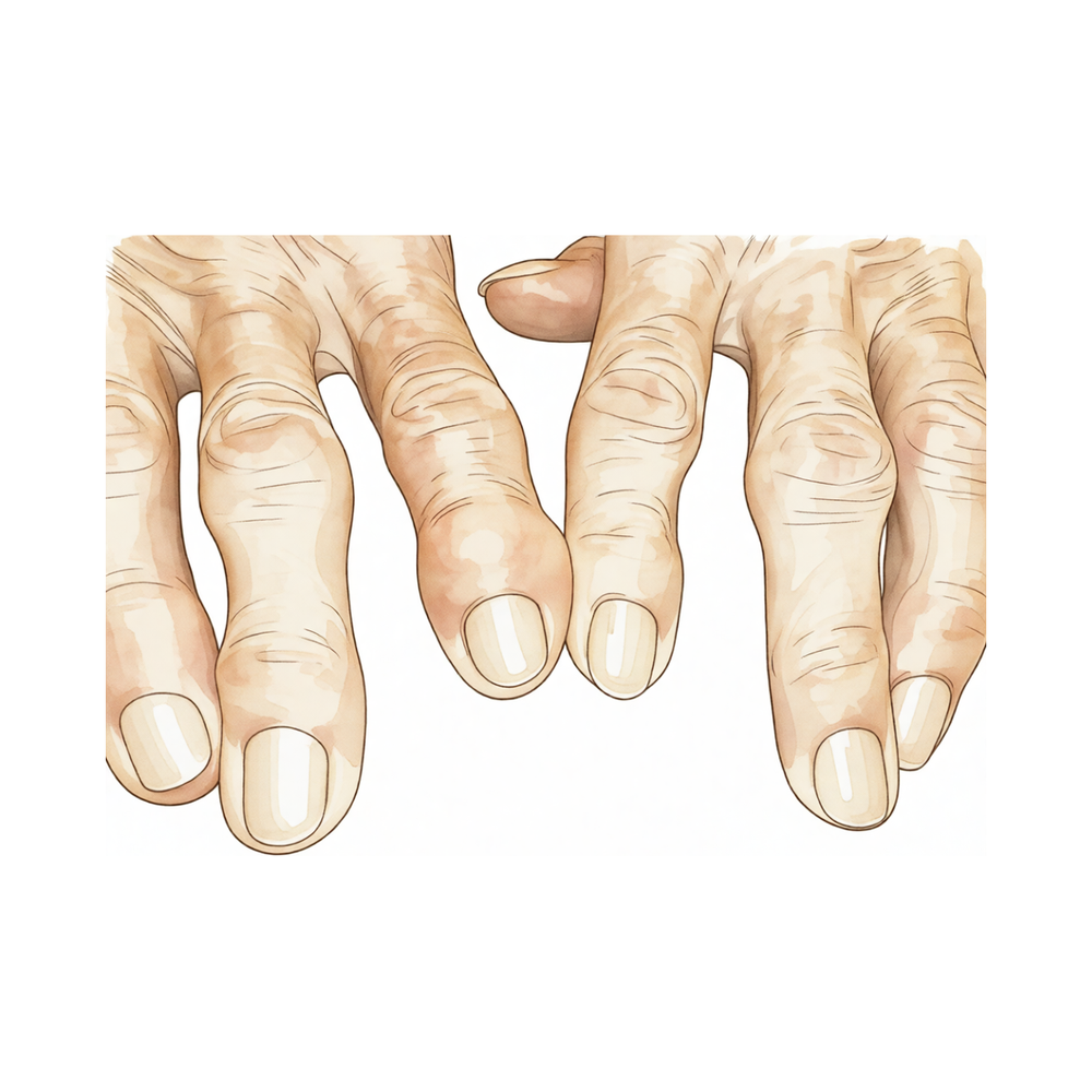 Osteoartrite
