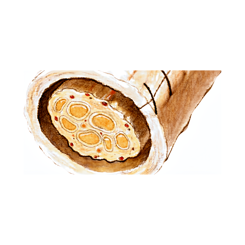 Envelopamento Nerve Wrap