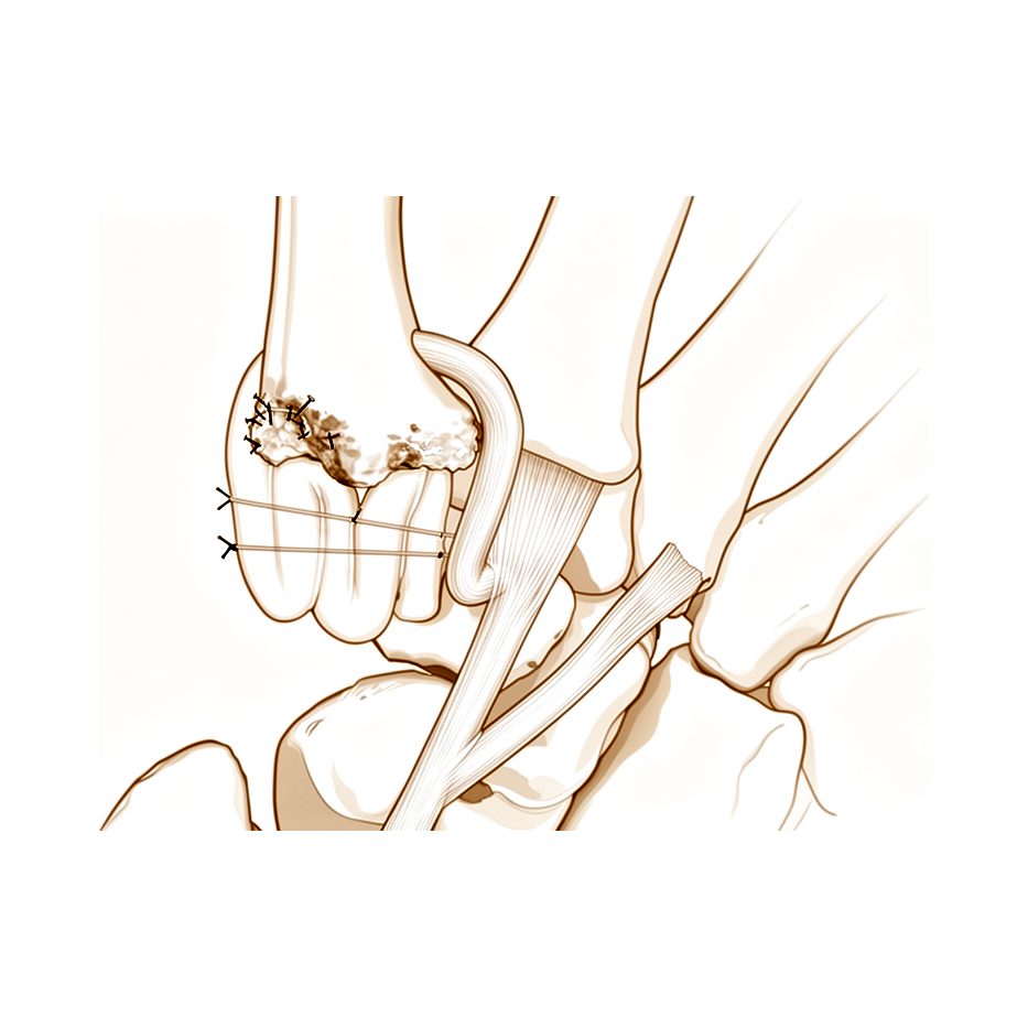 Trapeziectomia